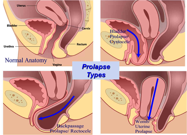 stages of pelvic organ prolapse